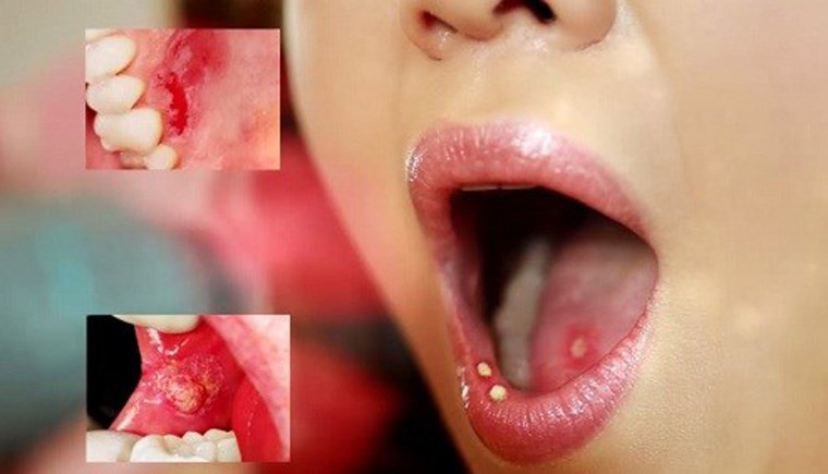 Những triệu chứng của bệnh ung thư miệng
