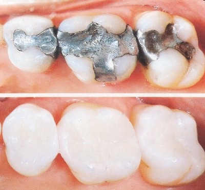 Bọc răng sứ cho răng sâu 1