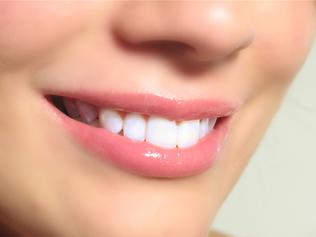 Bọc răng sứ khắc phục được tình trạng răng cửa thưa hiệu quả 2