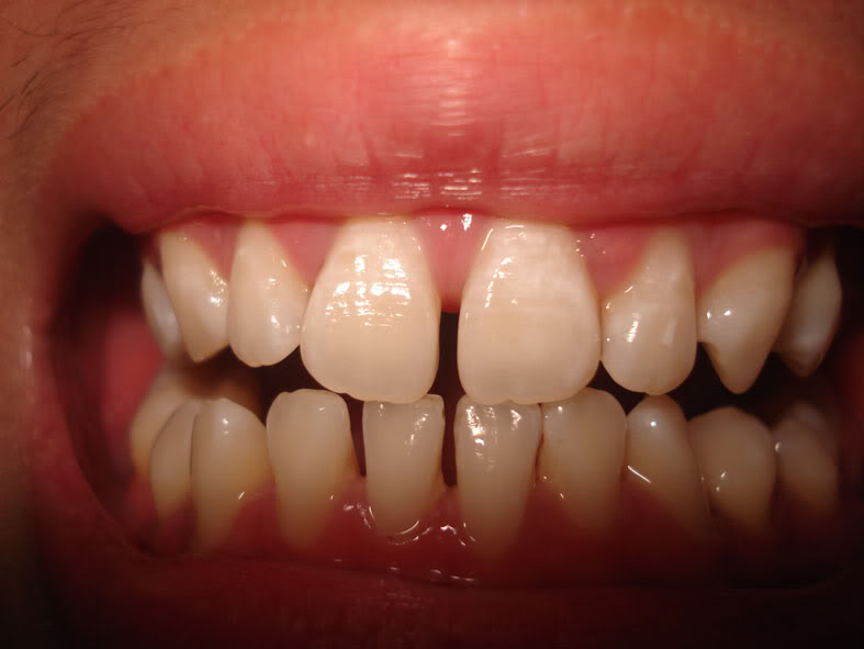Bọc răng sứ khắc phục răng cửa thưa