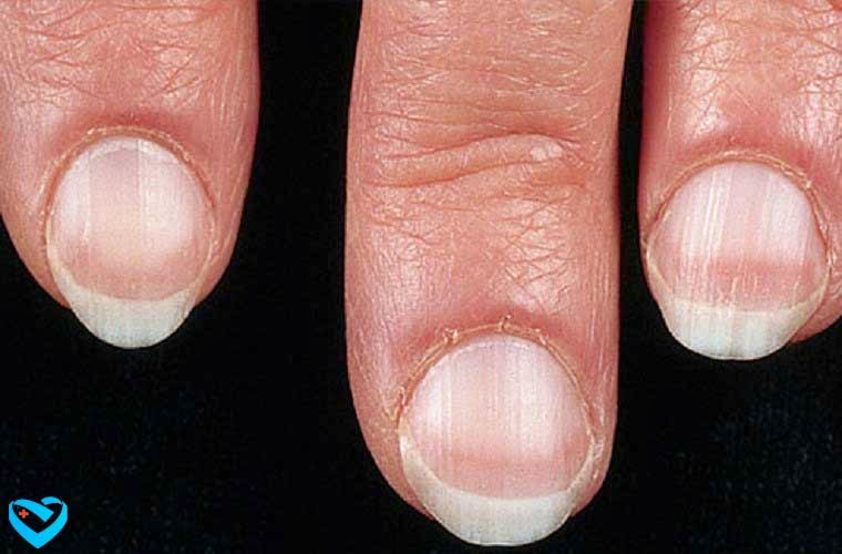 Những dấu hiệu bệnh tật thể hiện trên móng tay