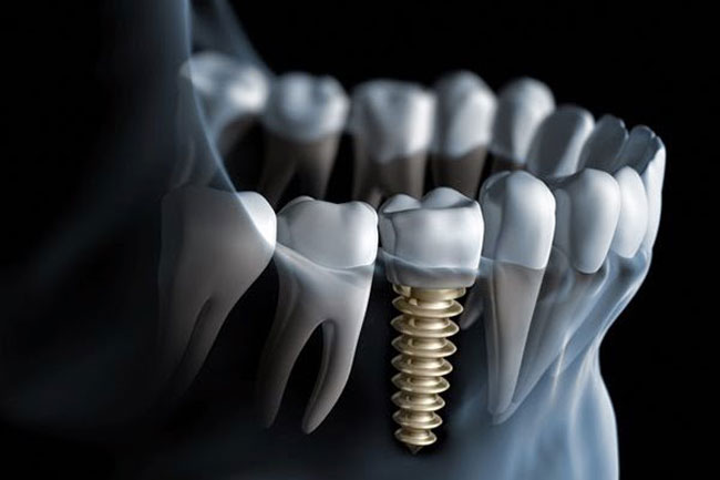 Ưu điểm của cấy ghép răng Implant