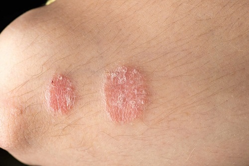 Các bệnh ngoài da thường gặp vào mùa hè
