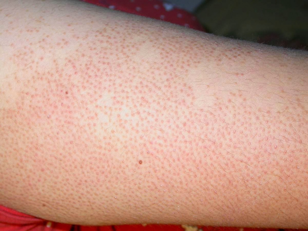 Các bệnh ngoài da thường gặp vào mùa hè 