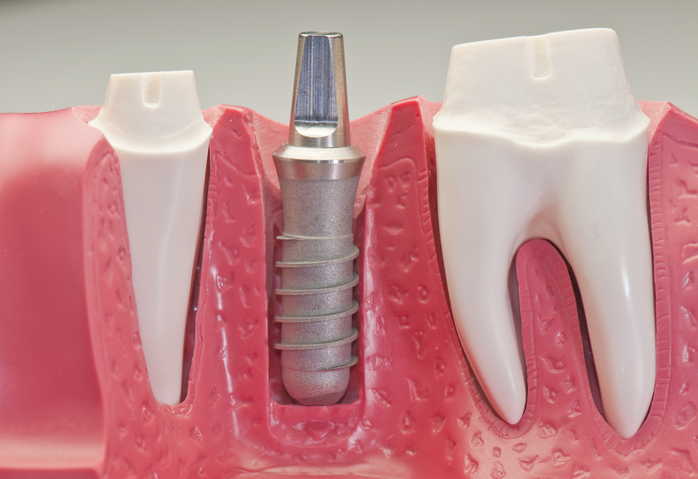 Trồng răng Implant có nguy hiểm không? 1