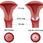 Liệu pháp điều trị mới cho ung thư cổ tử cung