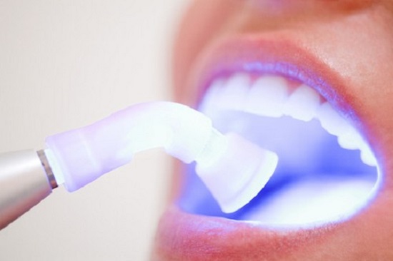 Tẩy trắng răng công nghệ Laser Whitening 2
