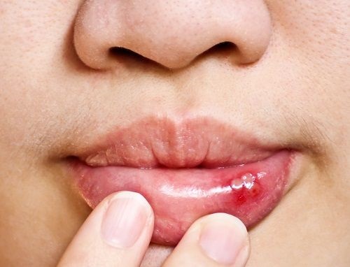 Cảnh giác và điều trị viêm loét miệng