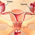 Phụ nữ mãn kinh dễ bị ung thư buồng trứng