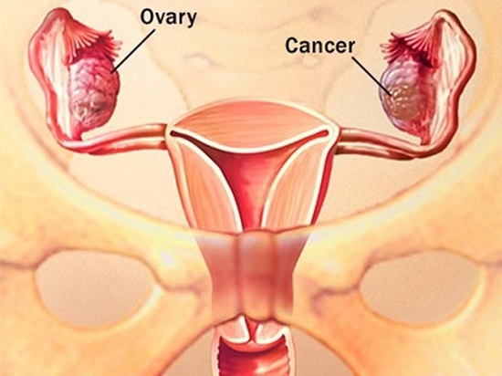 Phụ nữ mãn kinh dễ bị ung thư buồng trứng
