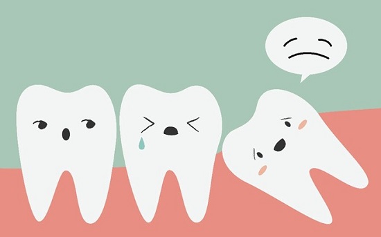 Làm gì khi bị đau do mọc răng khôn?