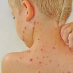 Cách xử lý khi bị dị ứng thực phẩm