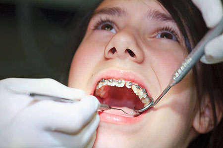 Quy trình niềng răng mắc cài 3M UGSL