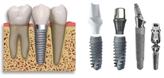 Vì sao trồng răng Implant lại có giá thành cao?