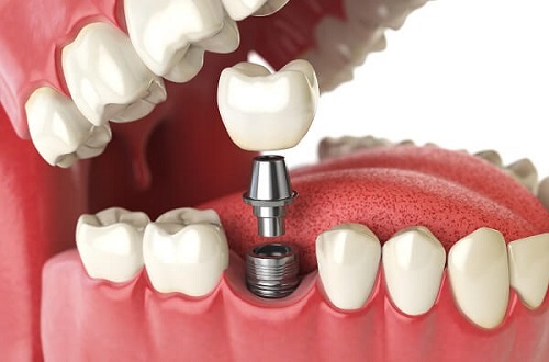 Cấy ghép răng implant mất thời gian bao lâu?