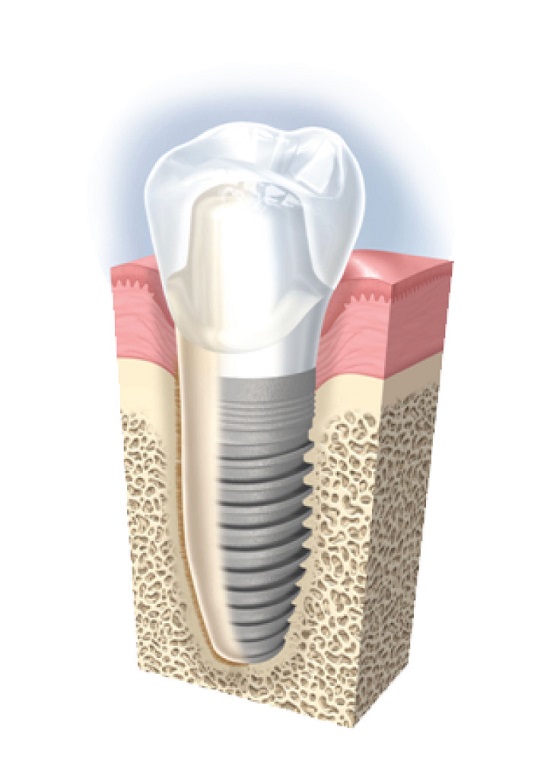 Cấy ghép răng implant mất thời gian bao lâu? 1