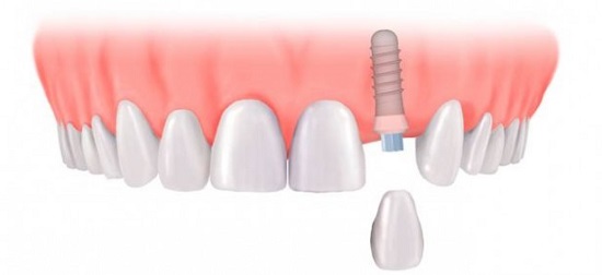 Cấy ghép răng implant mất thời gian bao lâu? 3