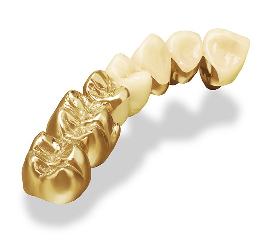 Răng implant giá bao nhiêu tiền?
