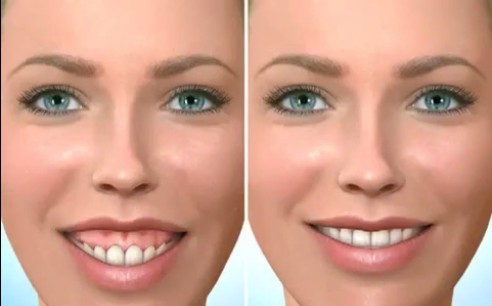 Chữa cười hở lợi công nghệ 3D trả lại cho bạn nụ cười duyên dáng