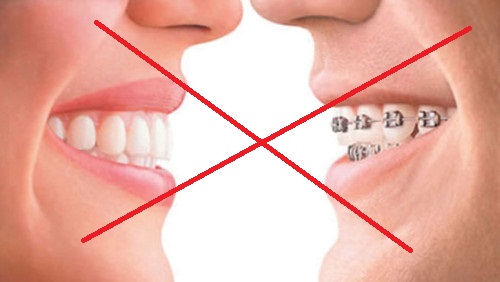 Phẫu thuật hàm hô không cần niềng răng 2