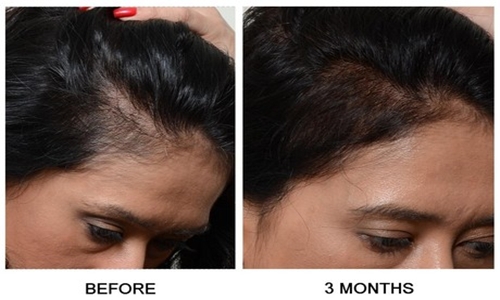 Điều trị hói đầu bằng phương pháp cấy tóc 3