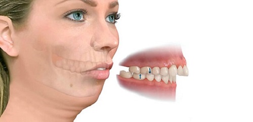 Phẫu thuật hàm hô vẩu móm