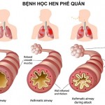 Cấy chỉ chữa hen phế quản