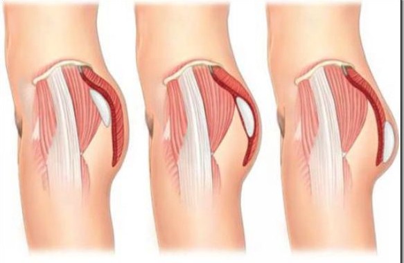 Phương pháp phẫu thuật nâng mông chảy xệ