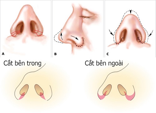 Thu gọn cánh mũi nội soi ở đâu đẹp?