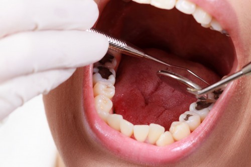 Nên làm gì khi bị sâu răng?