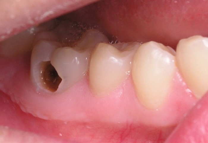 9 nguyên nhân gây sâu răng phổ biến