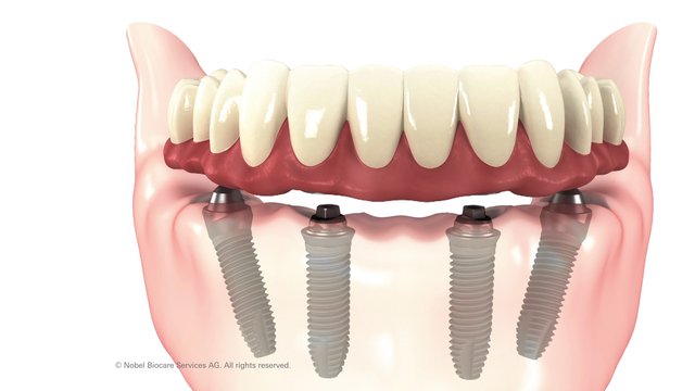 Kỹ thuật implant all on 4