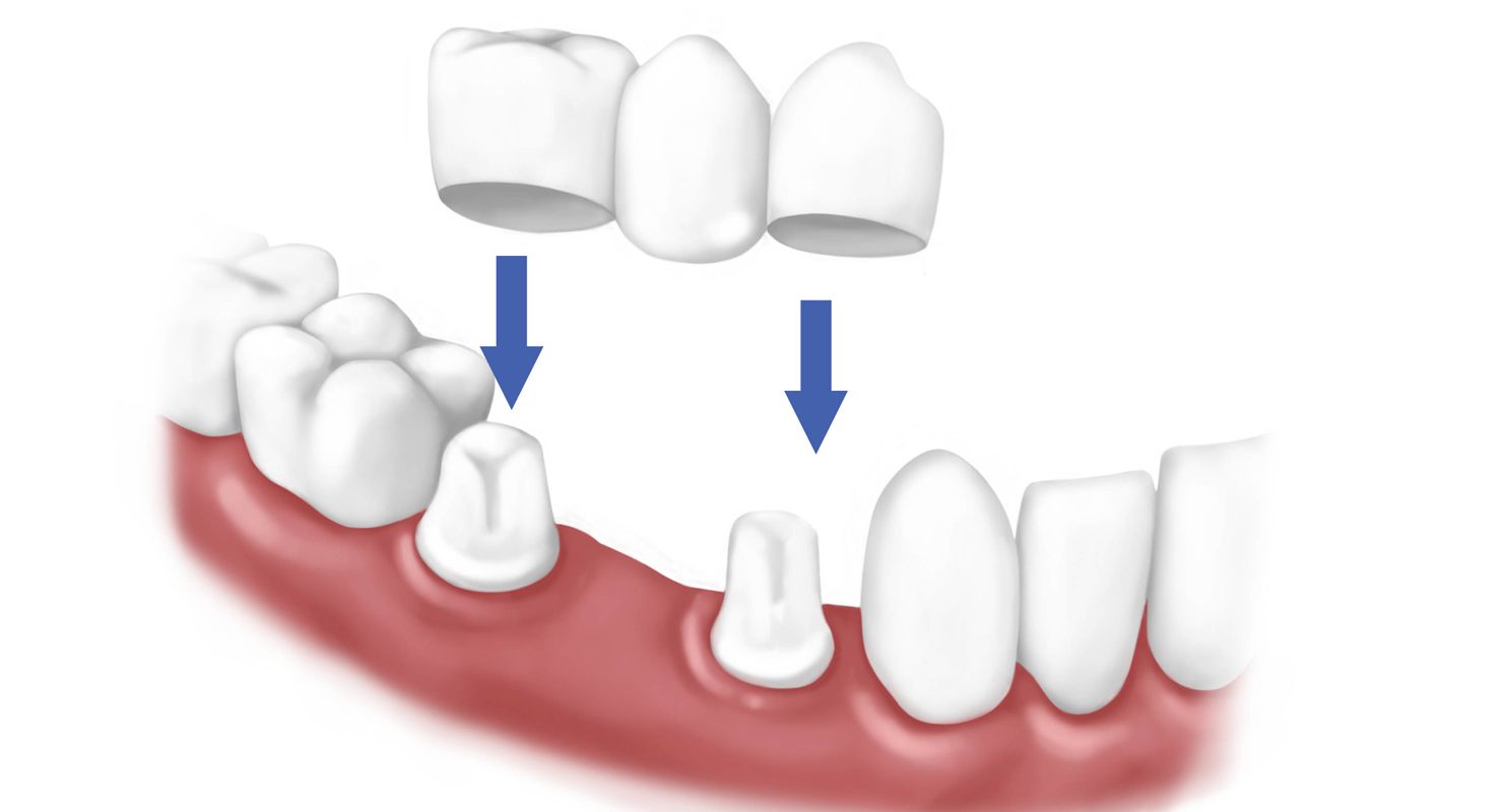 Làm răng Implant hay cầu răng giả?