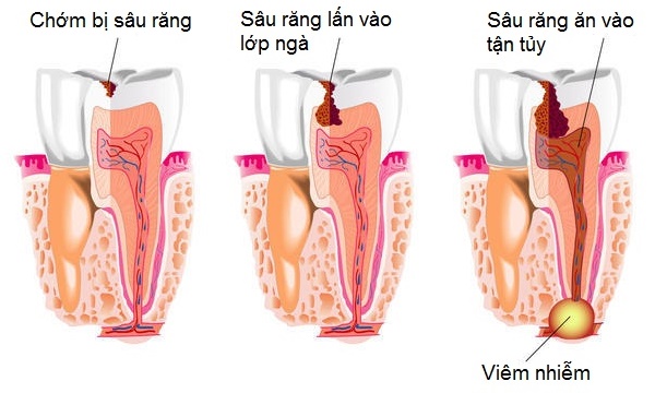 Bệnh sâu răng là gì? 1