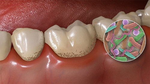 Bệnh sâu răng là gì? 2