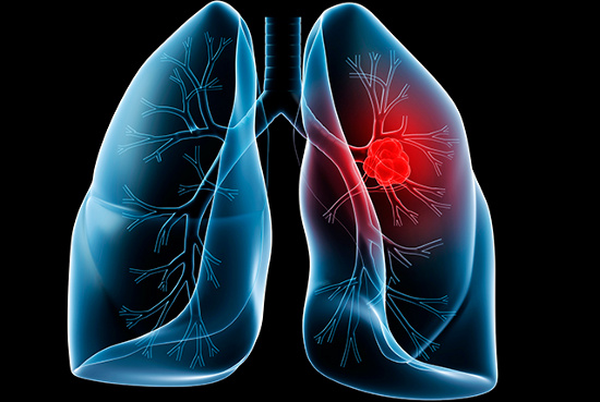 Dấu hiệu nhận biết sớm ung thư phổi 1