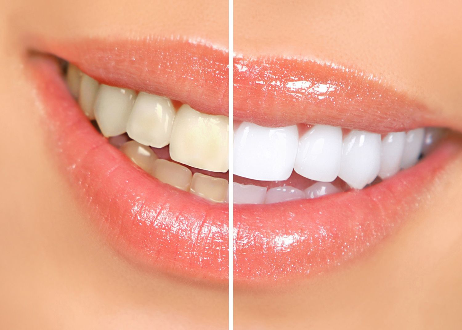 Những lưu ý trước và sau khi tẩy trắng răng