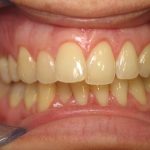 Những nguyên nhân khiến răng bị xỉn màu
