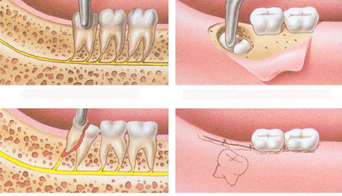 Cách chăm sóc sau khi nhổ răng khôn an toàn nhất