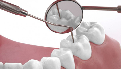 Cạo vôi răng có gây đau nhức răng miệng không?