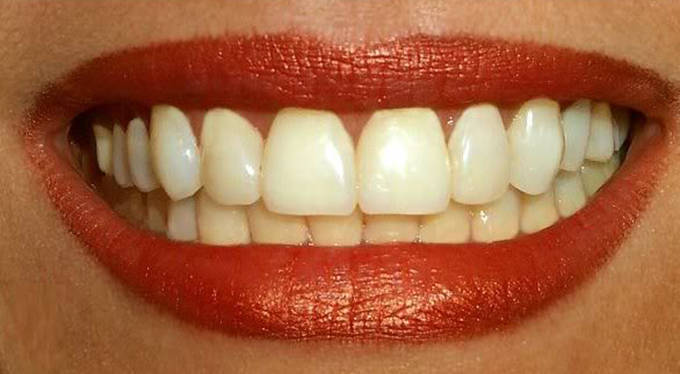 Những nguyên nhân khiến răng bị sậm màu