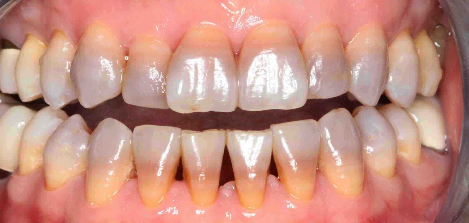 Những nguyên nhân khiến răng bị sậm màu