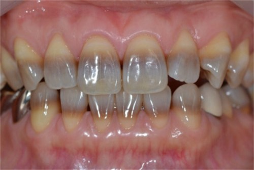 Nguyên nhân và cách khắc phục răng nhiễm kháng sinh tetracycline