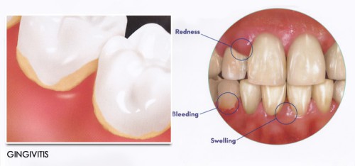 Những biểu hiện của bệnh viêm chân răng