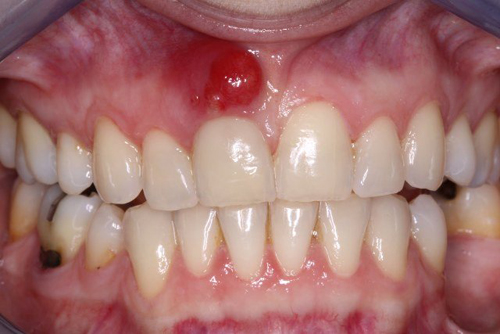 Những biểu hiện của bệnh viêm chân răng