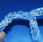 Những câu hỏi thường gặp về tẩy trắng răng