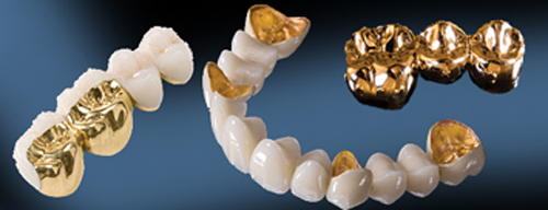 Những đặc điểm của răng sứ kim loại