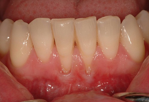 Những nguyên nhân gây đau nhức răng thường gặp