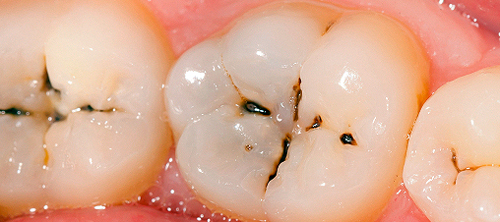 Răng hàm bị sâu nặng phải làm sao?