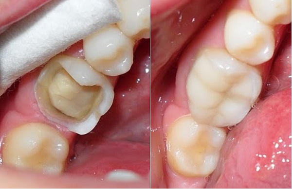 Răng hàm bị sâu nặng phải làm sao?
